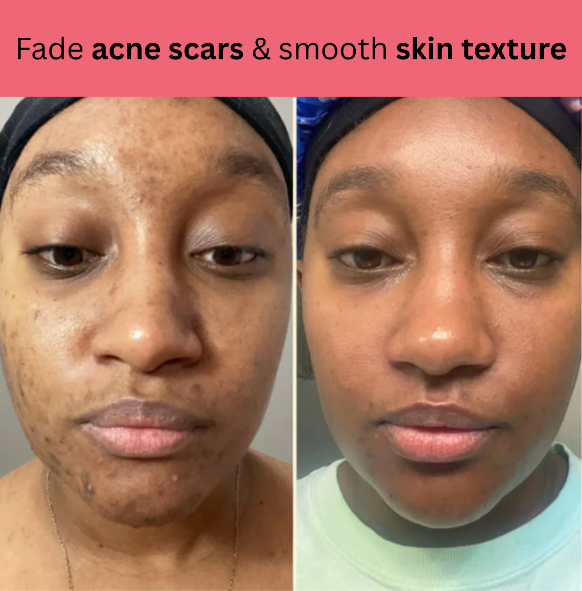 Kojic Acid Turmeric Overnight Mask